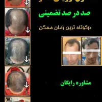 درمان قطعی ریزش و رویش مجدد مو