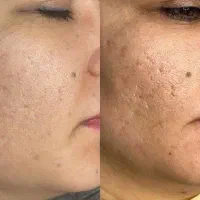 درمان لک با بیوممتیک اصل ایتالیا