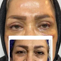 جشنواره بلفاروپلاستی در تبریز