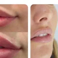 لب خوش فرم و طبیعی