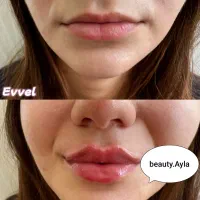 تزریق ژل و بوتاکس و مزو ( جوانسازی و روشن کننده)