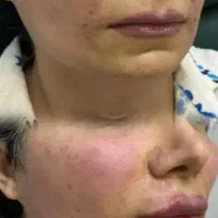 تخفیف فوق العاده خدمات ژل و بوتاکس در مطب|خدمات آرایشگری و زیبایی|شاهینشهر, بوستان حافظ|دیوار