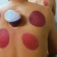 حجامت بادکش در منزل