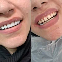 کامپوزیت دندان اقساطی|خدمات آرایشگری و زیبایی|قم, سراجه|دیوار