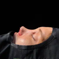 جراحی بینی گوشتی و استخوانی