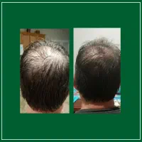 ریزش موهات قطع میشه با این راهی که میگم