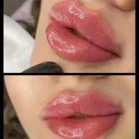 فیلر وبوتاکس