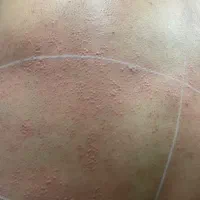 لیزر موهای زائد با دستگاه الکساندرایت کندلا (شاتی)|خدمات آرایشگری و زیبایی|قزوین, |دیوار