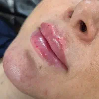تزریق فیلر صورت و بدن