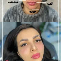 prp پی ارپی ژل فیلر بوتاکس نخ لیزر فیشیال هایفو|خدمات آرایشگری و زیبایی|مشهد, هفت تیر (حافظ)|دیوار