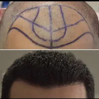 مشاوره کاشت مو،ابرو و کلیه خدمات زیبایی رایگان|خدمات آرایشگری و زیبایی|مشهد, فرهنگ|دیوار