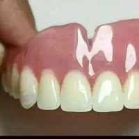 دندانسازی ساخت دندان مصنوعی متحرک باضمانت|آرایشی، بهداشتی، درمانی|مشکیندشت, |دیوار