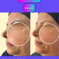 درمان حرفهای لک و ککومک و مزو تراپی|خدمات آرایشگری و زیبایی|برازجان, |دیوار