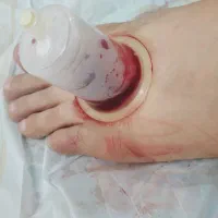 انواع بادکش وانواع حجامت وچکش درمانی .