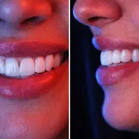 دندانپزشکی بااقساط ۱۲ ماه کامپوزیت ایمپلنت عصبکشی