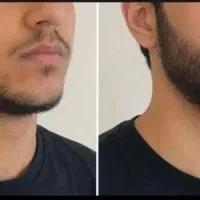 مولتی ویتامین ریش و مو