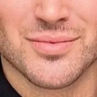 آفر زاویه سازی صورت آقایان و بانوان با تزریق فیلر