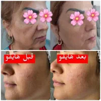 لیزرموهای زائدالکساندرایت،تنگ کردن وروشن کردن واژن|خدمات آرایشگری و زیبایی|کرج, کارخانه قند|دیوار