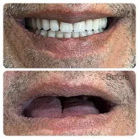 ساخت و تعمیر دندان مصنوعی/مواد آلمانی/نقد و اقساط|خدمات آرایشگری و زیبایی|چناران, |دیوار