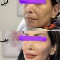 تخفیف عجیب غریب جوانسازو فیلر (پزشک)