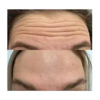 تزریق بوتاکس توسط پزشک
