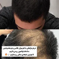 کاشت مو سوپر نچرال بدون جراحی|خدمات زیبایی و سلامت|شیراز, ستارخان|دیوار