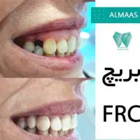 کامپوزیت از فکی ۴ تومن / بلیچینگ / بریج|خدمات آرایشگری و زیبایی|اهواز, زیتون کارمندی|دیوار