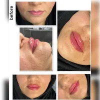 تزریق ژل و بوتاکس