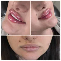 جشنواره یلدایی تخفیف ژل لب،بوتاکس توسط پزشک متخصص|خدمات آرایشگری و زیبایی|کرج, گلشهر|دیوار