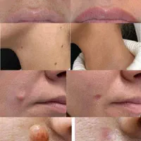 لیزر خال برداری.جوانسازی