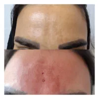 پی آرپی و مزوتراپی و سلول بنیادی