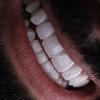 دندانپزشکی کامپوزیت ایمپلنت دندان اوردنچر ارتودنسی|خدمات آرایشگری و زیبایی|سهند, |دیوار