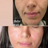 آف هفتگی تزریق ژل و بوتاکس و مزوژل جوانساز|خدمات آرایشگری و زیبایی|آمل, |دیوار