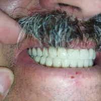 لابراتوار دندانسازی، دندان مصنوعی|آرایشی، بهداشتی، درمانی|تبریز, |دیوار