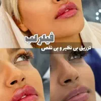 تخفیفات فیلر لب، ژل لب، بوتاکس، مزوژل و لیفت نخ