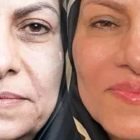 پوست صورتتو حداقل ۵ سال جوان تر کن (مزوژل اختصاصی)