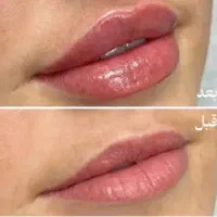 مدل ژل/فیلر لب|خدمات آرایشگری و زیبایی|تهران, قلهک|دیوار