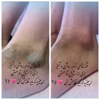 ررفع خشکی و تیرگی قوزک پا 200هزارتومن