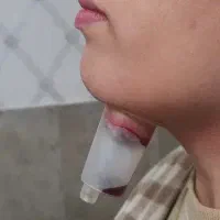 انجام حجامت.زالودرمانی.درمان سردردوسینوزیت بافصد