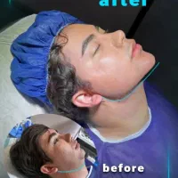 آف 50% ساکشن غبغب سوپر کانتور VLine بدون عمل جراحی|خدمات آرایشگری و زیبایی|مشهد, هفت تیر (آب و برق)|دیوار