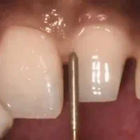 میخای تو 30 جلسه دندانسازی رو آموزش ببینی|خدمات آموزشی|ارومیه, |دیوار