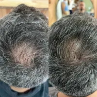 رفع ریزش مو کاملاگیاهی|آرایشی، بهداشتی، درمانی|احمدی, |دیوار