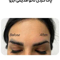 رفع تیرگی بدن  و لیزر تتوهای قدیمی بدن و صورت|خدمات آرایشگری و زیبایی|یاسوج, |دیوار