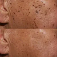 خال خالبرداری لیپوم غده چربی میخچه میلیا تگ پوستی|خدمات آرایشگری و زیبایی|تهران, صادقیه|دیوار
