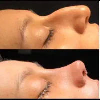 عمل بینی. جراحی بینی.