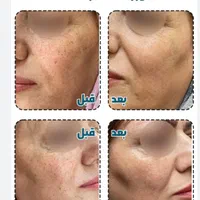 تخفیف لیزر تخصصی لک وکک و مک