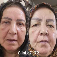بلفاروپلاستی|خدمات آرایشگری و زیبایی|اصفهان, عمان سامانی|دیوار