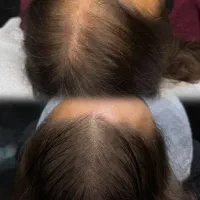 درمان قطعی ریزش مو و رویش مجدد|آرایشی، بهداشتی، درمانی|پارس‌آباد, |دیوار