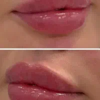 ژل و بوتاکس/ ژل لب/کانتورینگ عربی/روسی|خدمات آرایشگری و زیبایی|فردیس, فردیس|دیوار