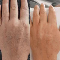 رفع کک و مک و لک . خال . اسکین تگ در یک جلسه|خدمات آرایشگری و زیبایی|بیرجند, |دیوار